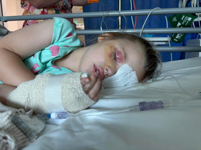 Four-year-old Luca de Groot, who suffered severe eye injuries when a washing machine tablet ruptured and went into her eyes.