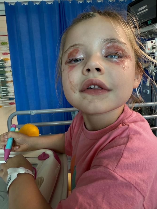 The 4 year old’s eyes were stuck shut and she required eyedrops every hour for a week. 
